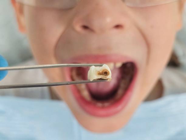 Best Knocked-Out Tooth (Avulsed Tooth) Treatment in Whitewater, WI